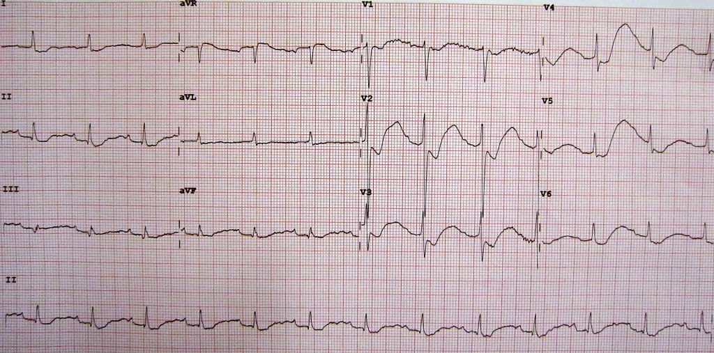 Hypokalemia and Hyperkalemia | ACLS.com